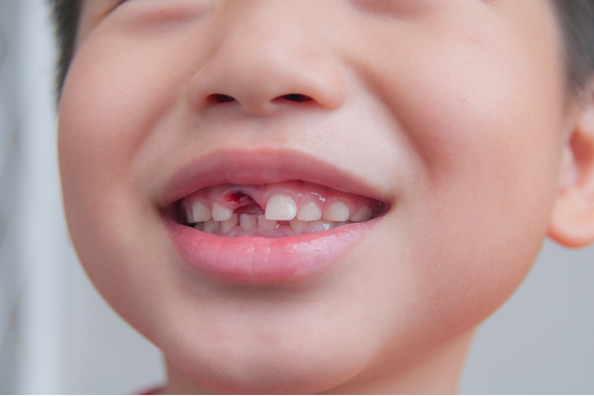 Does Your Child’s Permanent Tooth Still Grow If It’s Broken