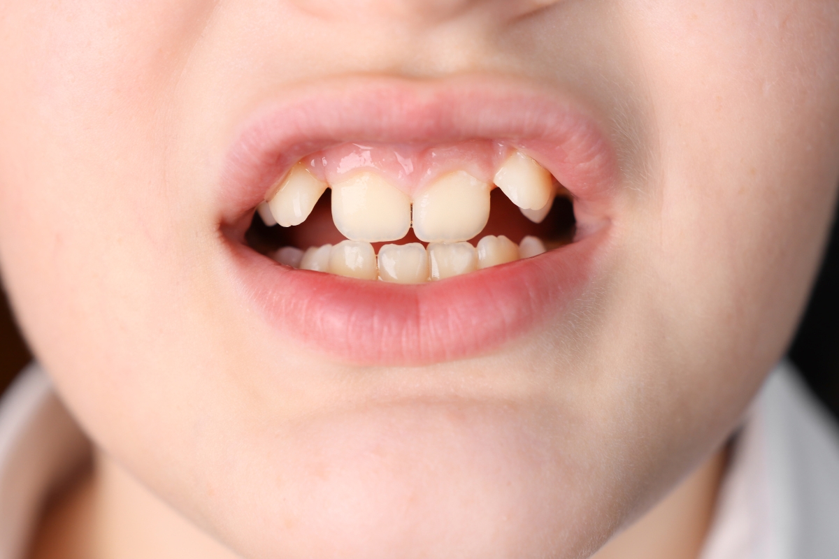What Are Impacted Teeth and How Can They Be Treated in Children